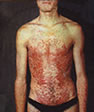 before-treatment-psoriasis